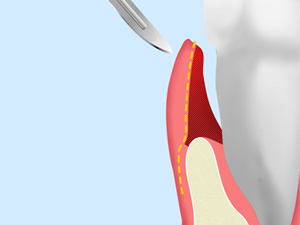 歯肉弁根尖側移動術（APF）