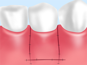 遊離歯肉結合組織移植術および結合組織移植術