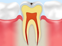 ごく初期の虫歯【CO】