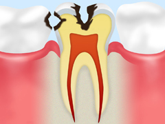 象牙質の虫歯【C2】