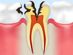 神経に達した虫歯【C3】