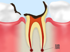 歯根に達した虫歯【C4】