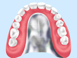 金属床義歯