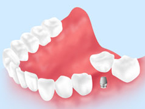 インプラントについて