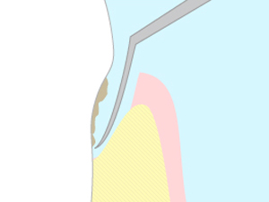 Widman改良法フラップ手術(WMF)