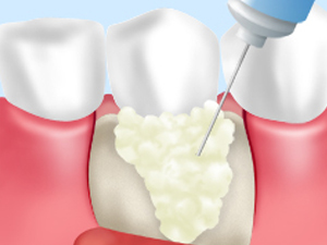 歯周組織再生療法