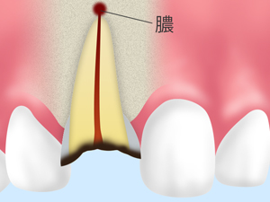 歯根尖切除術