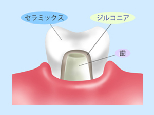 ジルコニア